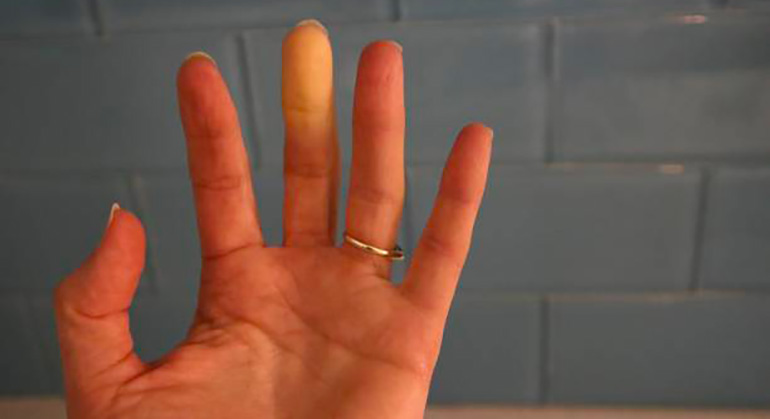 Syndrome de Raynaud