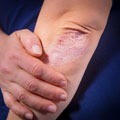 Le psoriasis