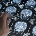 La maladie d'Alzheimer