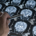 La maladie d'Alzheimer