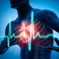 L'infarctus du myocarde